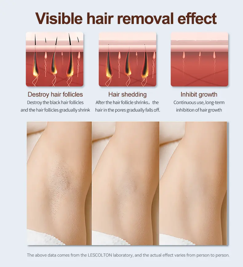 ICE Laser Hair Removal