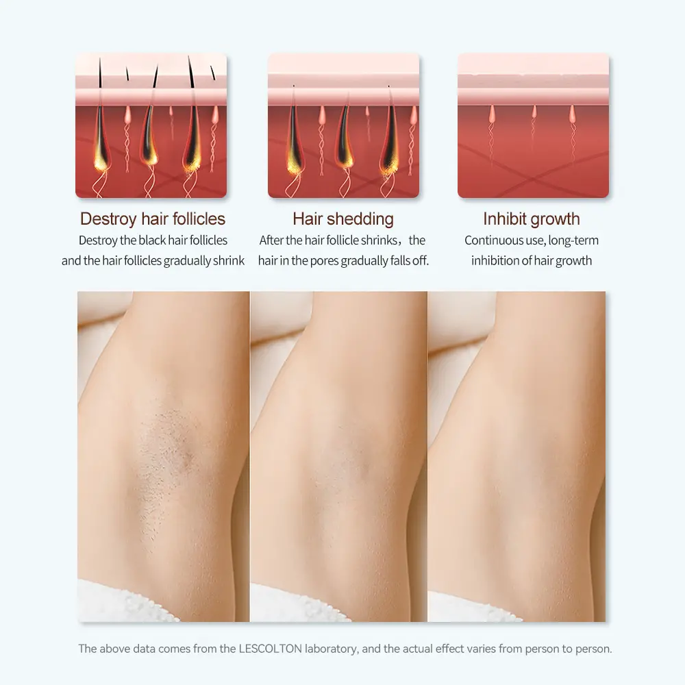 permanent hair removal