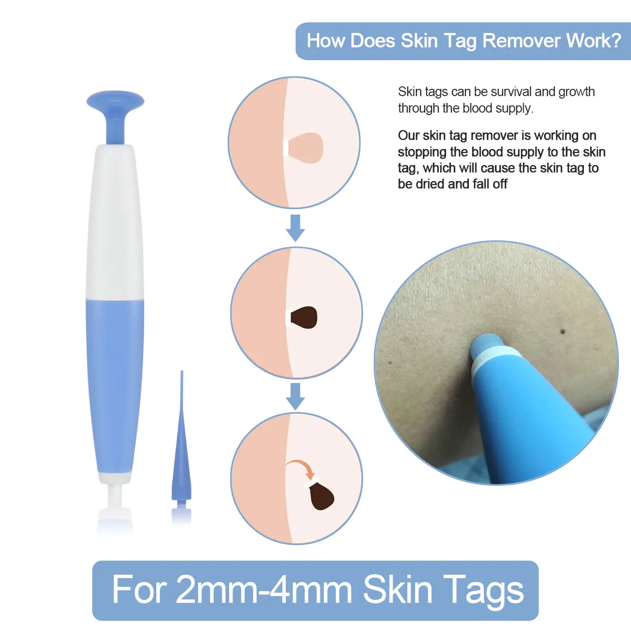 skin tag removal kit
