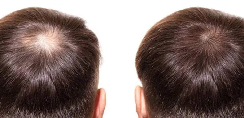 Best Laser Caps for Hair Loss