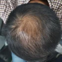 Understanding the Science Behind Hair Loss: Causes and Solutions